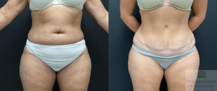 Before & After Abdominoplasty - tummy tuck Case 53 Front View in Rochester, NY