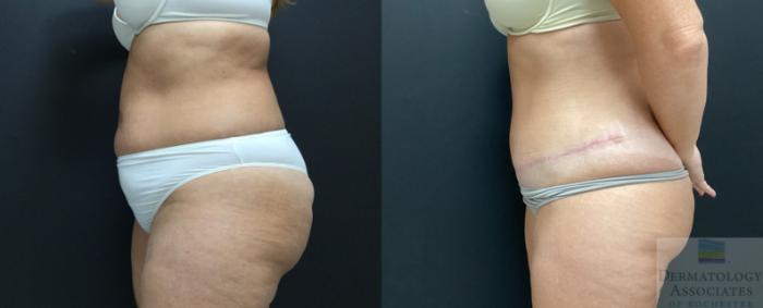 Before & After Abdominoplasty - tummy tuck Case 53 Left Side View in Rochester, NY