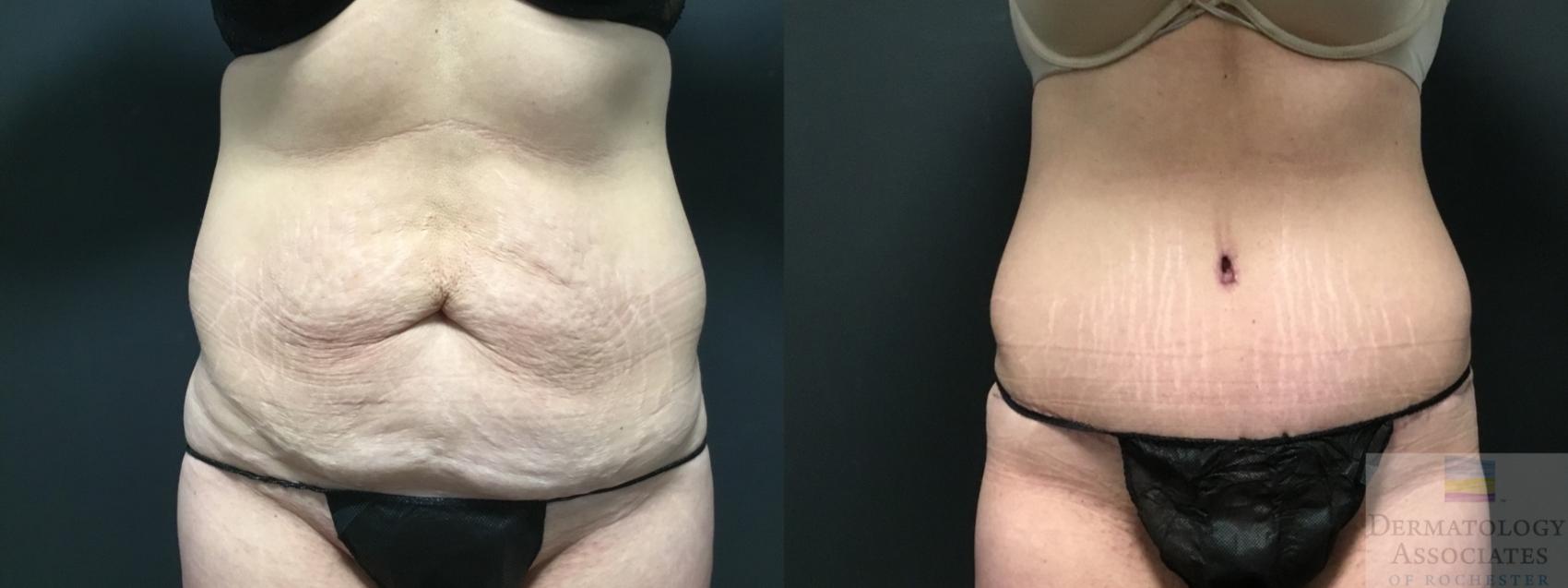 Before & After Abdominoplasty - tummy tuck Case 6 Front View in Rochester, NY