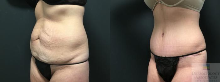 Before & After Abdominoplasty - tummy tuck Case 6 Left Oblique View in Rochester, NY