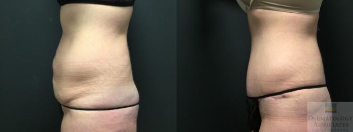 Before & After Abdominoplasty - tummy tuck Case 6 Left Side View in Rochester, NY