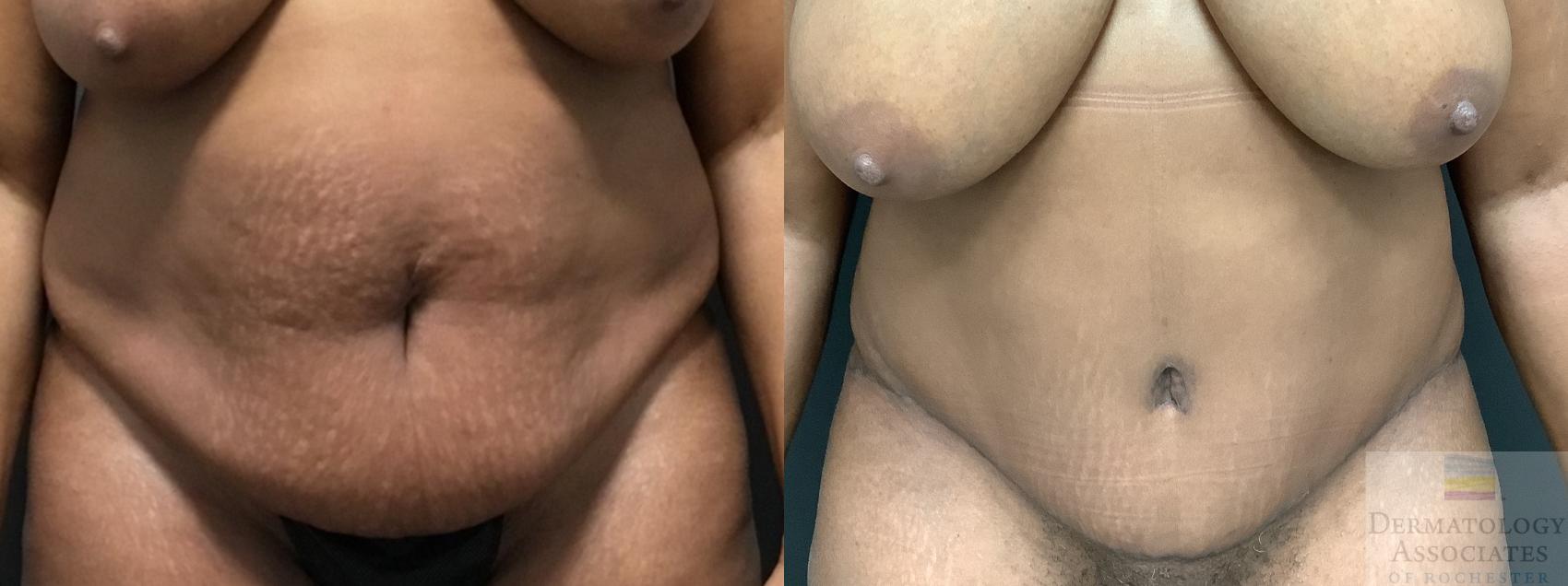 Before & After Abdominoplasty - tummy tuck Case 7 Front View in Rochester, NY