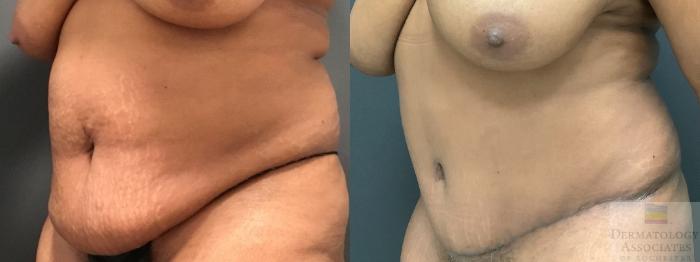 Before & After Abdominoplasty - tummy tuck Case 7 Left Oblique View in Rochester, NY