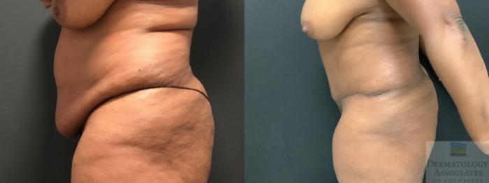 Before & After Abdominoplasty - tummy tuck Case 7 Left Side View in Rochester, NY