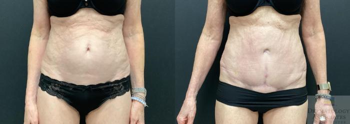 Before & After Abdominoplasty - tummy tuck Case 70 Front View in Rochester, NY