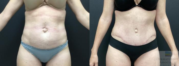Before & After Abdominoplasty - tummy tuck Case 83 Front View in Rochester, NY