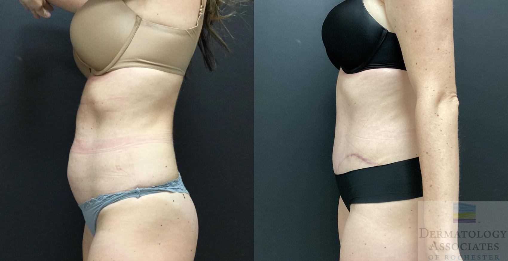 Before & After Abdominoplasty - tummy tuck Case 83 Left Side View in Rochester, NY