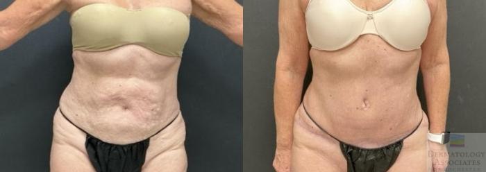 Before & After Liposuction Case 97 Front View in Rochester, NY