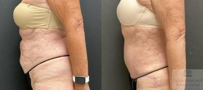 Before & After Abdominoplasty - tummy tuck Case 97 Left Side View in Rochester, NY