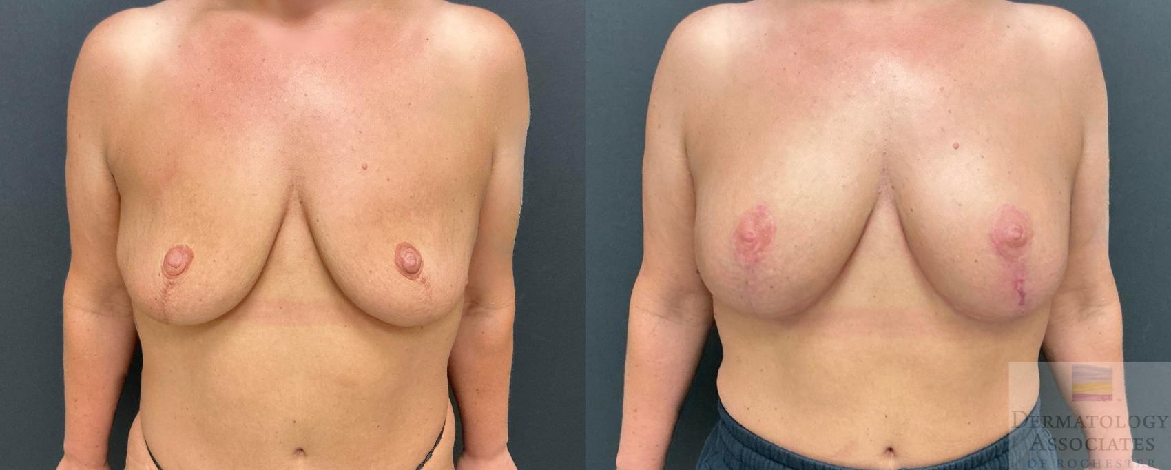Before & After Augmentation Mastopexy - lift with implant Case 124 Front View in Rochester, NY