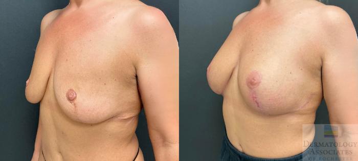 Before & After Augmentation Mastopexy - lift with implant Case 124 Left Oblique View in Rochester, NY