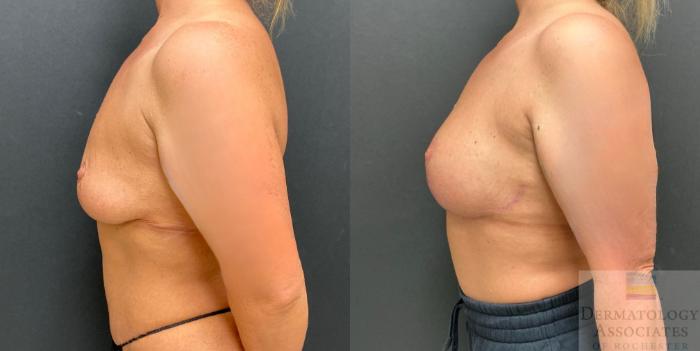 Before & After Augmentation Mastopexy - lift with implant Case 124 Left Side View in Rochester, NY