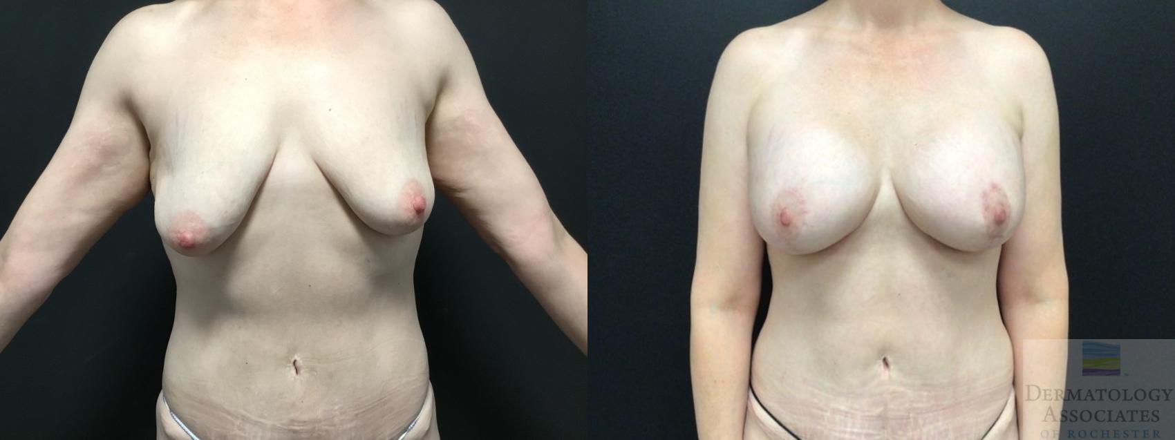 Before & After Augmentation Mastopexy - lift with implant Case 4 Front View in Rochester, NY