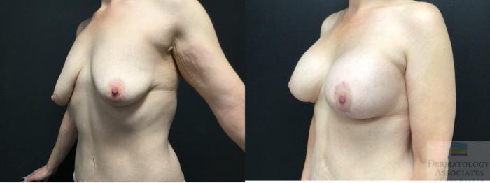 Before & After Augmentation Mastopexy - lift with implant Case 4 Left Oblique View in Rochester, NY