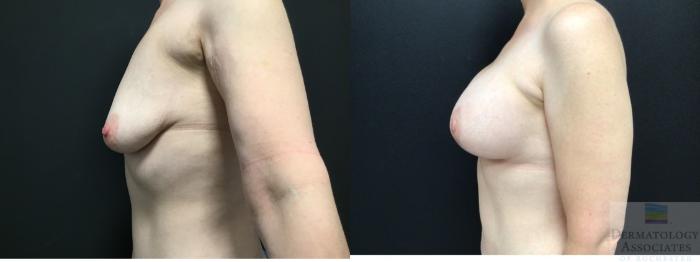 Before & After Augmentation Mastopexy - lift with implant Case 4 Left Side View in Rochester, NY