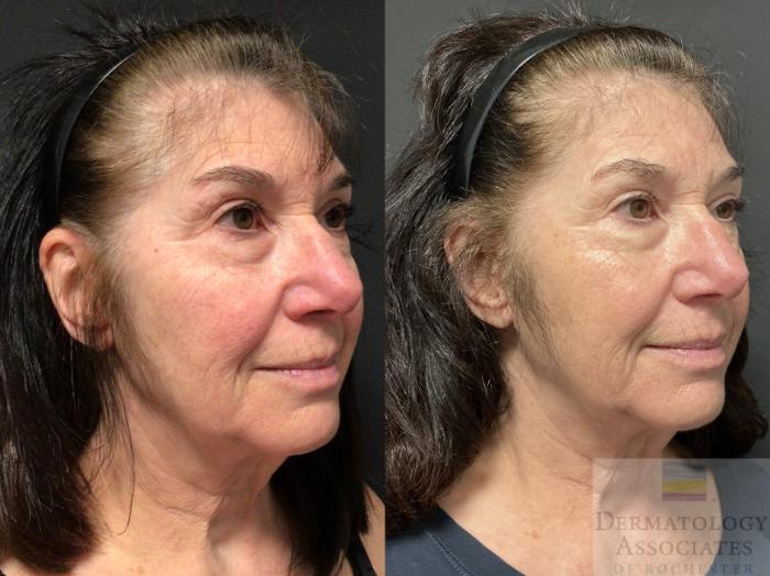 Before & After AVAVA Case 80 Right Oblique View in Rochester, NY