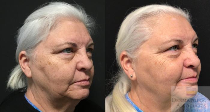 Before & After BBL Case 73 Right Angle View in Rochester, NY