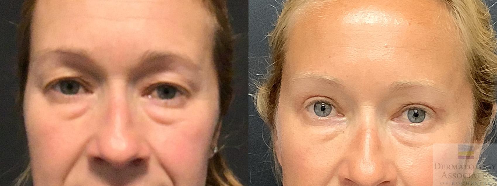 Before & After Blepharoplasty Case 10 Front View in Rochester, NY