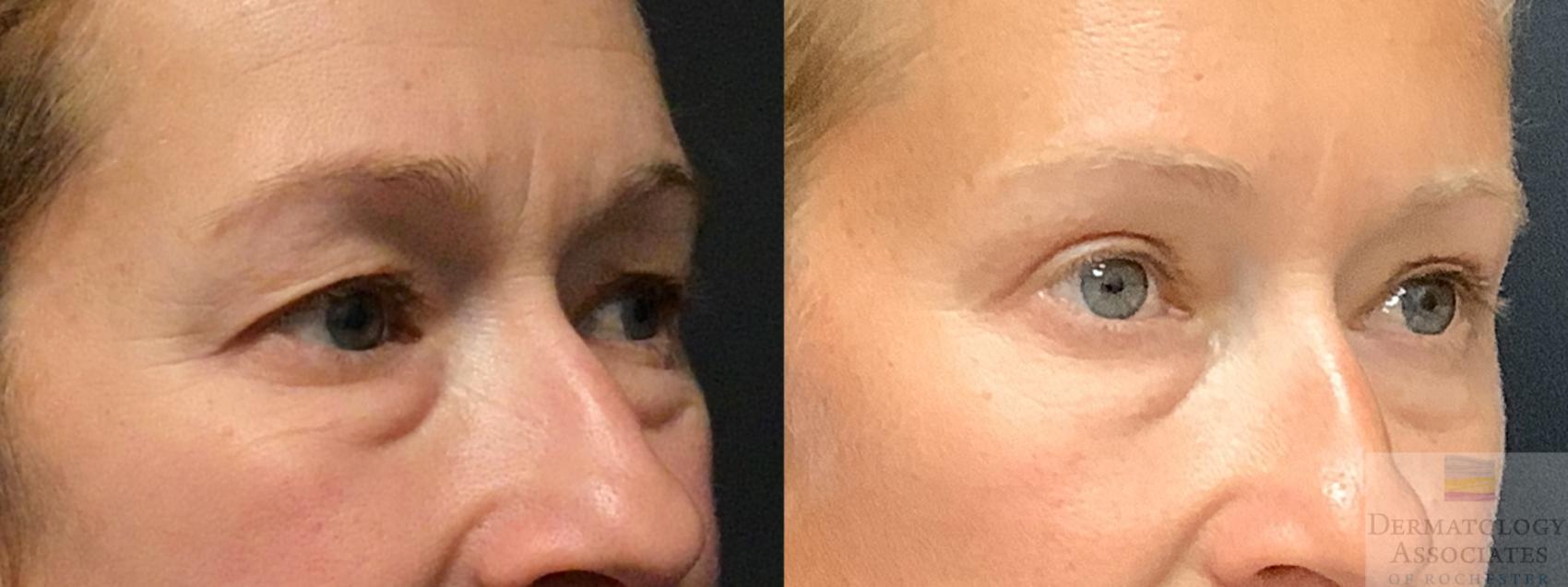 Before & After Blepharoplasty Case 10 Right Oblique View in Rochester, NY
