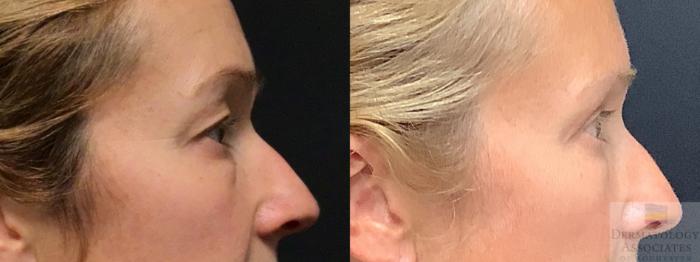 Before & After Blepharoplasty Case 10 Right Side View in Rochester, NY