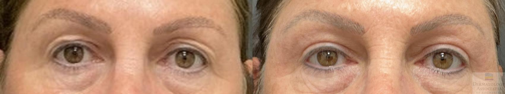 Before & After Blepharoplasty Case 106 Front View in Rochester, NY