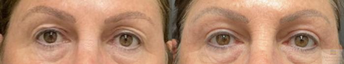 Before & After Blepharoplasty Case 106 Front View in Rochester, NY