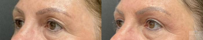 Before & After Blepharoplasty Case 106 Left Angle View in Rochester, NY