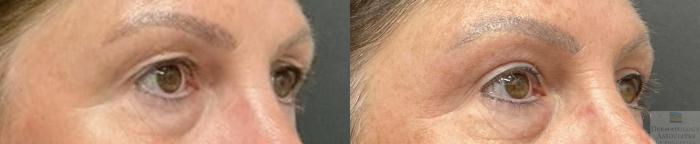 Before & After Blepharoplasty Case 106 Right Angle View in Rochester, NY
