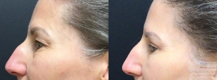 Before & After Blepharoplasty Case 11 Left Side View in Rochester, NY