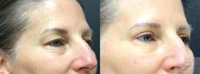 Before & After Blepharoplasty Case 11 Right Oblique View in Rochester, NY