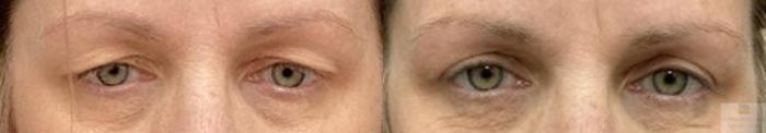 Before & After Blepharoplasty Case 115 Front View in Rochester, NY