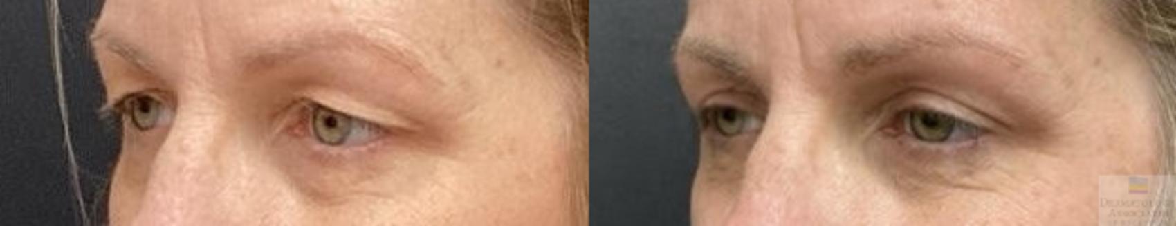 Before & After Blepharoplasty Case 115 Left Angle View in Rochester, NY