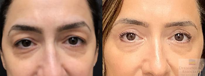 Before & After Blepharoplasty Case 13 Front View in Rochester, NY