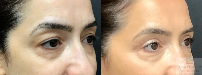 Before & After Blepharoplasty Case 13 Right Oblique View in Rochester, NY