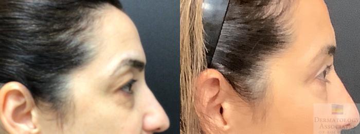 Before & After Blepharoplasty Case 13 Right Side View in Rochester, NY