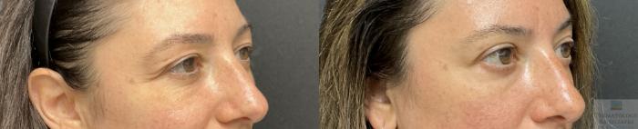Before & After Blepharoplasty Case 133 Angle View in Rochester, NY