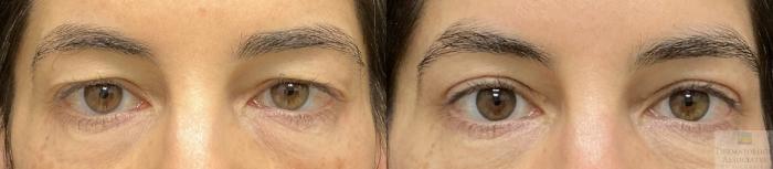 Before & After Blepharoplasty Case 142 Front View in Rochester, NY