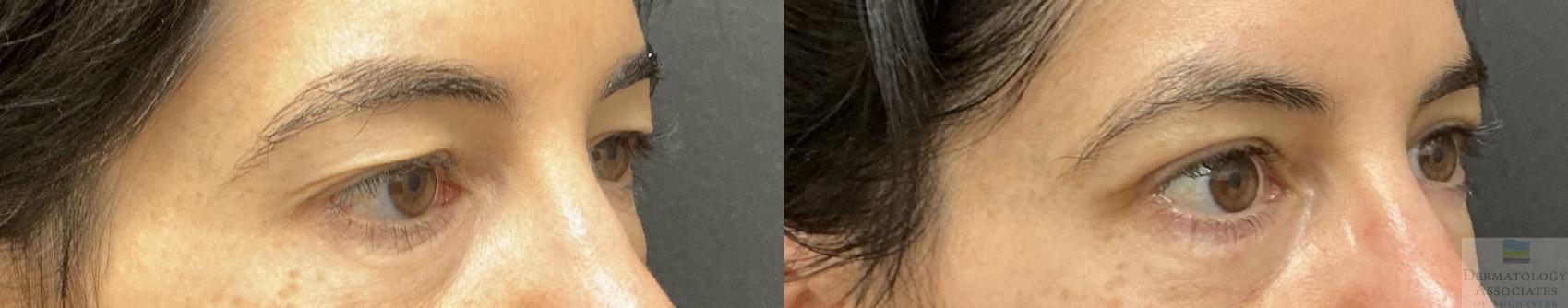 Before & After Blepharoplasty Case 142 Right Oblique View in Rochester, NY