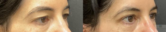 Before & After Blepharoplasty Case 142 Right Oblique View in Rochester, NY