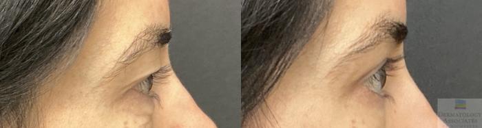 Before & After Blepharoplasty Case 142 Right Side View in Rochester, NY