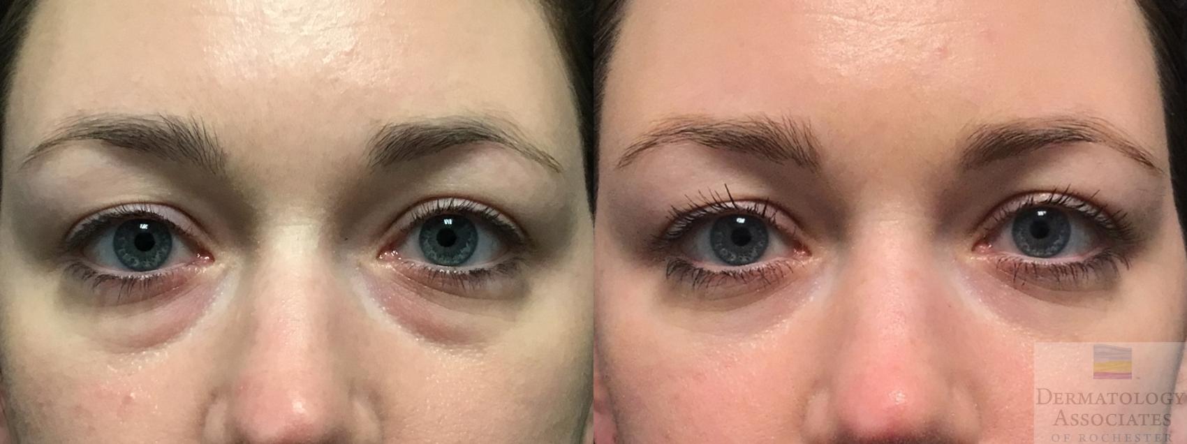 Before & After Blepharoplasty Case 20 Front View in Rochester, NY
