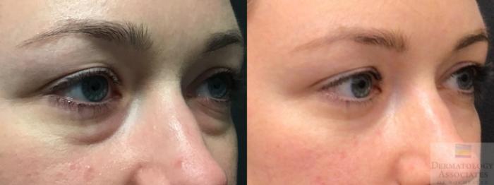 Before & After Blepharoplasty Case 20 Right Oblique View in Rochester, NY