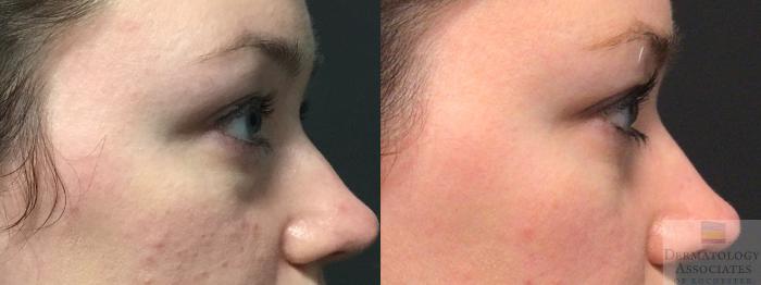Before & After Blepharoplasty Case 20 Right Side View in Rochester, NY