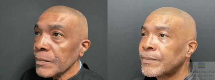 Before & After Blepharoplasty Case 50 45 Degree Angle - Left Side View in Rochester, NY