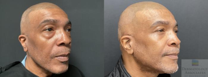 Before & After Blepharoplasty Case 50 45 Degree Angle - Right Side View in Rochester, NY