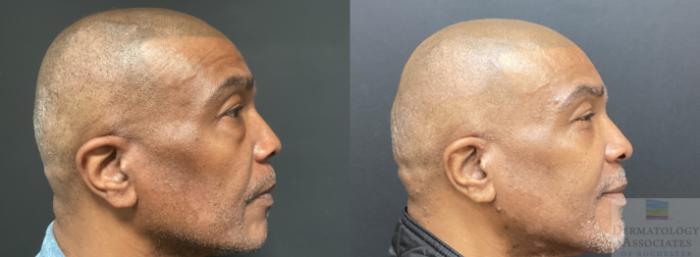 Before & After Blepharoplasty Case 50 Right Side View in Rochester, NY