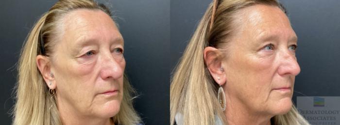 Before & After Blepharoplasty Case 57 Angle View in Rochester, NY