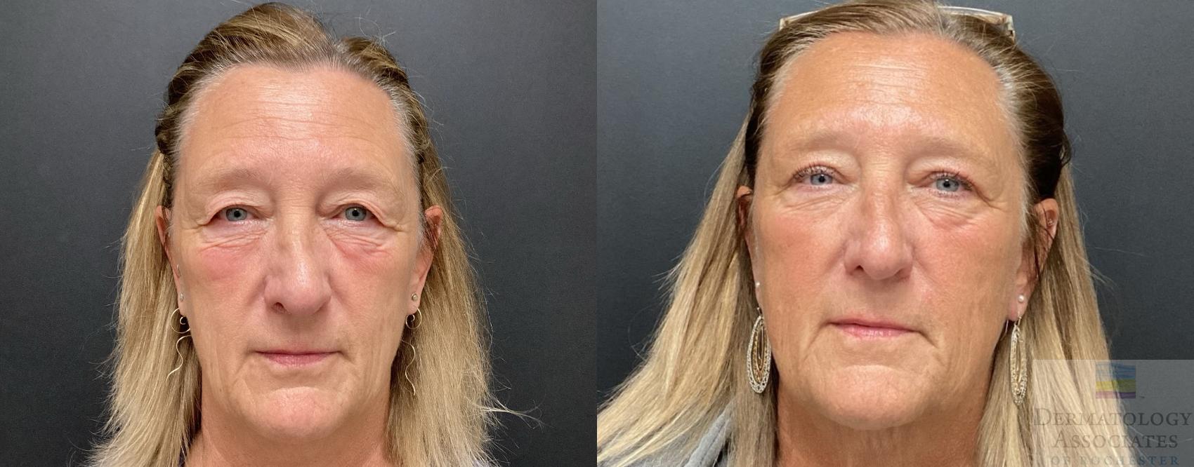 Before & After Blepharoplasty Case 57 Front View in Rochester, NY