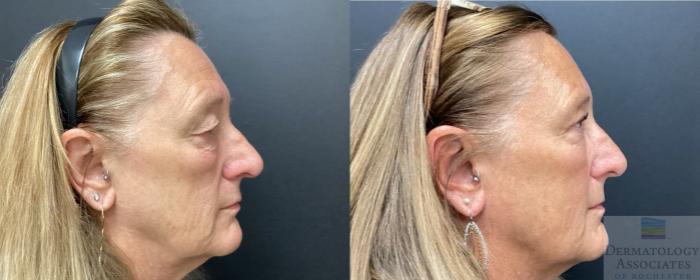 Before & After Blepharoplasty Case 57 Right Side View in Rochester, NY