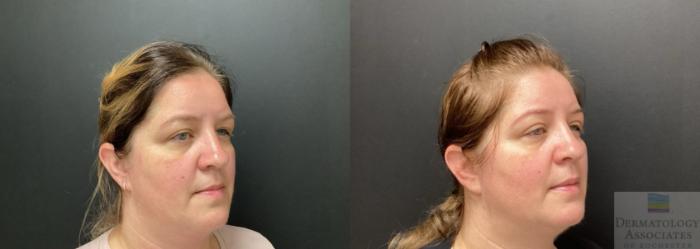 Before & After Blepharoplasty Case 58 45 Degree Angle - Right Side View in Rochester, NY